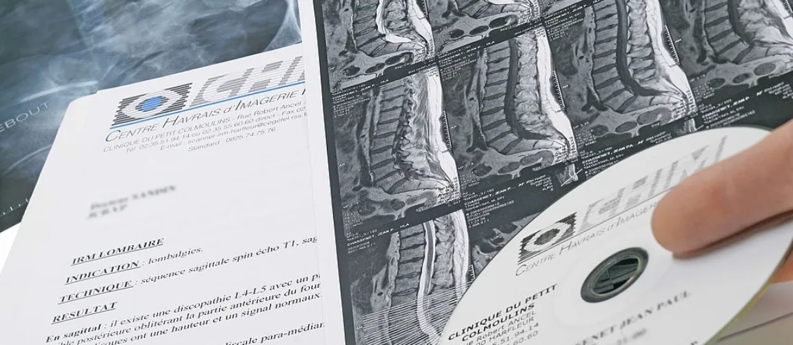 Me duele la espalda porque tengo una hernia discal lumbar